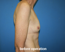 plastic-surgery-breast-augmentation